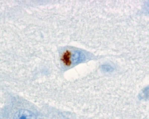 IHC显示棕色的的聚-GA聚集在一个的C9orf72突变载波海马