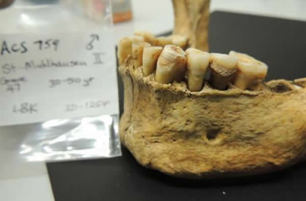 对古人类牙石中保留的细菌DNA的研究