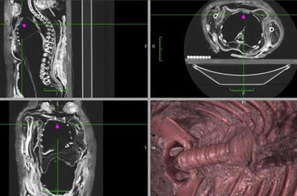 研究人员对加拿大皇家安大略博物馆一具木乃伊尸体空腹体腔进行了CT切片和3D结构重建