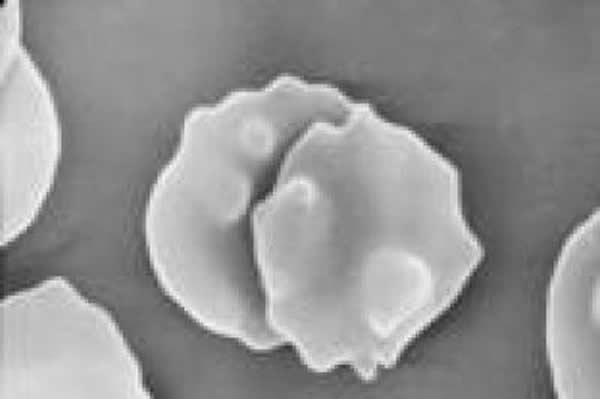 扫描电镜(×8000)见舞蹈病-棘红细胞增多症患者外周血中的棘状红细胞。