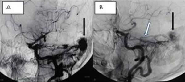 61岁男性患者行右枕部硬脑膜动静脉瘘手术前(A)和10年后(B)的血管造影。白箭头示右侧小脑上动脉扩大,这一动脉供血给术后10年残存的枕部硬脑膜动静脉瘘,黑箭头