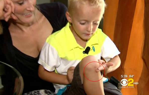 美国4岁男孩膝盖中“孵”出海蜗牛