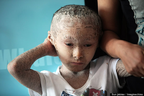 小杭患有遗传性罕见疾病「鱼鳞癣」