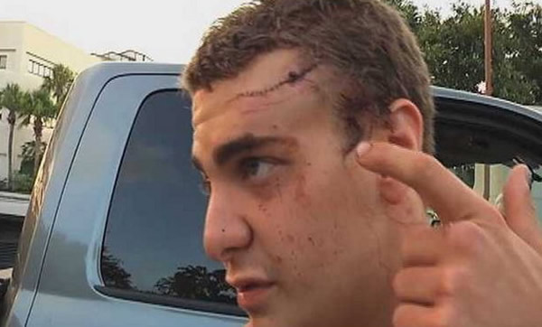 美国少年在湖泊中游泳错把鳄鱼当浮木惨遭攻击