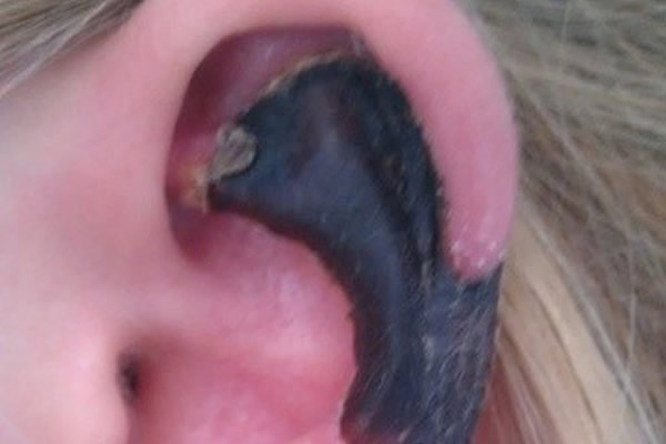 荷兰妙龄女到意大利旅游,耳朵被蜘蛛咬成黑色