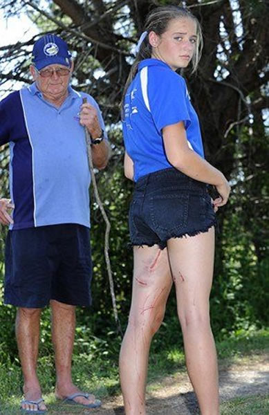 澳大利亚新州猎人谷13岁女孩被一只袋鼠“打”得伤痕累累