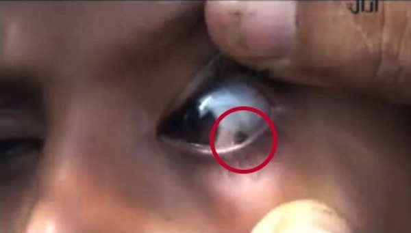 叶门12岁少女流泪时会哭出石头