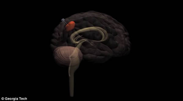 新技术可将癌细胞“钓”出大脑