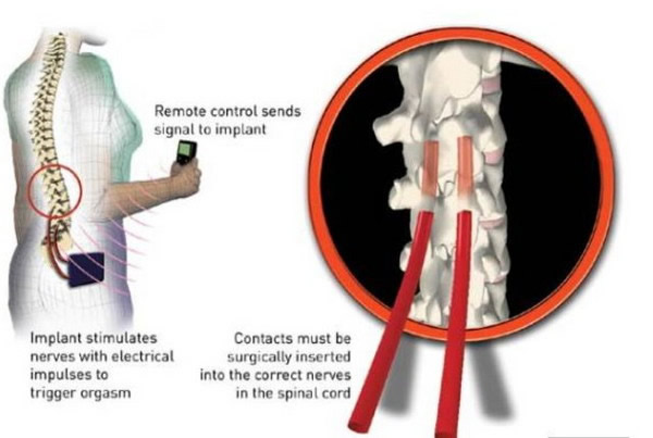 把装置植入女性体内后跟脊髓连接,即可以用遥控方式掌控性高潮。