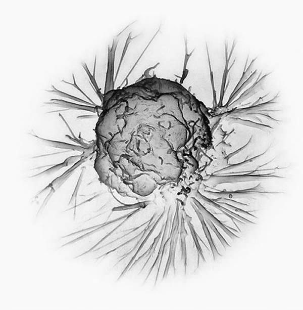 乳腺癌细胞电镜照