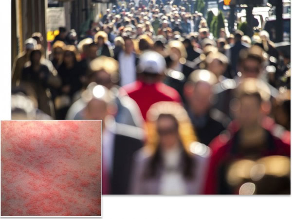 在纽约等城市,麻疹疫苗接种率约为90%,插图为患病的皮肤。