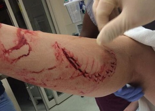 沃恩的腿部有明显被咬过所造成的伤痕