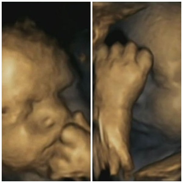 4Dɨ��ͼƬ����ĸ�׷���ʱ��̥�������Ĵ���Ҳ���ӡ�