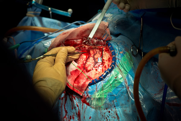 他一面移除部分肿瘤,一面在这个区域释放电流,以判断邻近的神经元是否为动作功能所需要的。 「这名病患仍保有许多动作功能,」马克西姆.德斯寇托表示。他是制作这张大脑