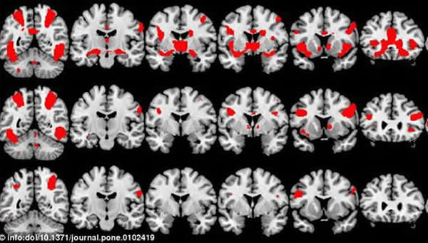 最新研究表明,性瘾者与吸毒者具有十分接近的大脑活动性,实验显示以上两个群体的3个特殊大脑区域在色情作品和毒品刺激下都会激活。