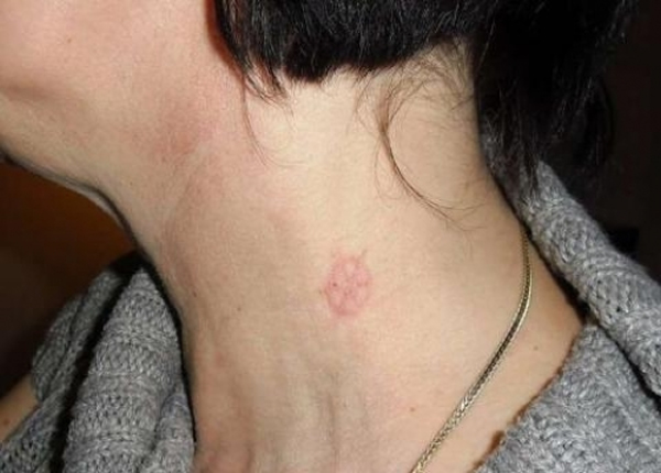 波兰妇人:2厘米左右的符号突然出现在身上