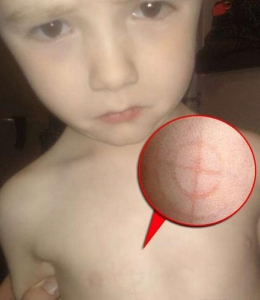 英国一名4岁男童胸前无原无故浮现出一个象征魔鬼的十字准星符号,父母被吓了一跳。