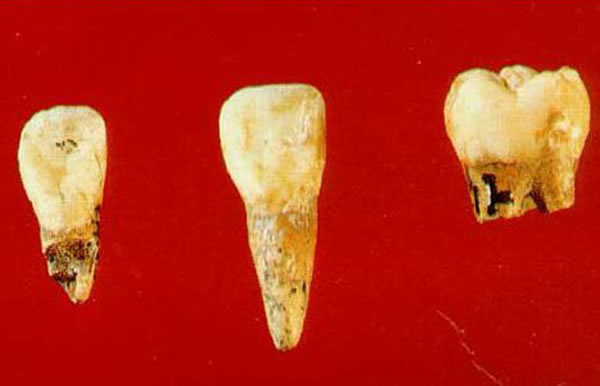 出土的丁村人牙齿化石