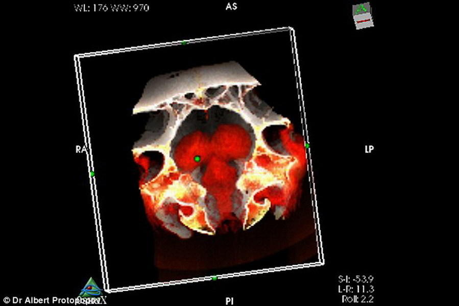冰河时代末期西伯利亚北部冰冷气候条件冰冻了野牛的大脑,从而时隔9300年,考古学家发现这只野牛的大脑结构完整保存下来。如图所示,这是对野牛大脑的CT扫描图像。科