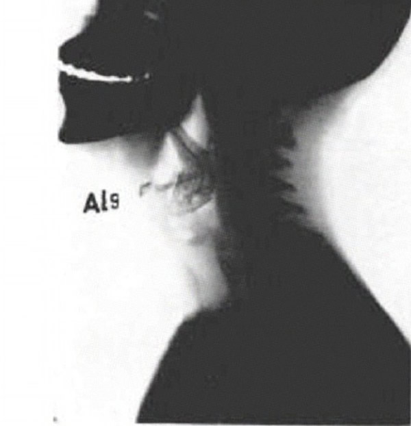 孟加拉少年捕鱼险遭6.5吋长鳗鱼鲠死