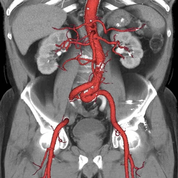 高清的动态扫描影像,可清晰重塑腹部及大动脉的情况。