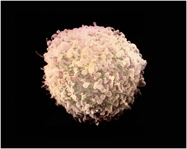 基因疗法首次降伏HIV 或可促“功能性治愈”艾滋病