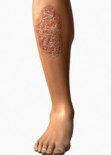 移植尸皮疗伤的技术,在烧伤等伤口亦有所帮助。