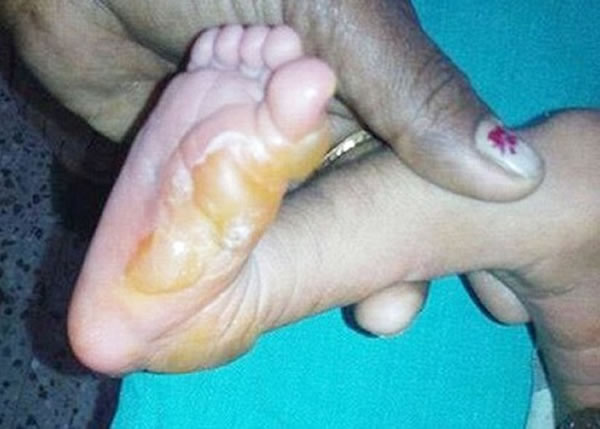 拉杰斯瓦丽称次子也出现自燃现象,送院证实脚部烧伤。