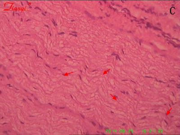 以牵拉神经根的方法制备C6臂丛神经损伤动物模型,造模后即刻用微量注射器接无菌玻璃拉丝针头将人羊膜上皮细胞悬液缓慢注入到臂丛神经损伤区,24周后苏木精-伊红染色显