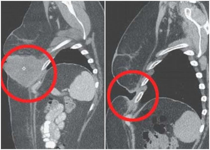 女患者经新混合疗法后,左胸下的巨型肿瘤 (左图)神奇消失,皮肤留下一个大洞(右图)。