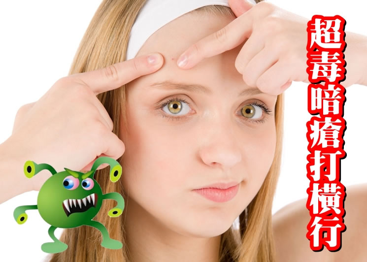 多达8成暗疮患者,服食多种抗生素后未见成效。