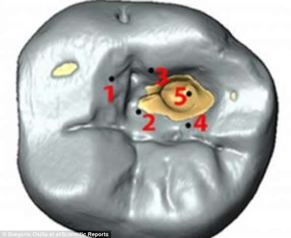 史前牙医?1.4万年前牙齿化石上发现人类治疗牙病的痕迹