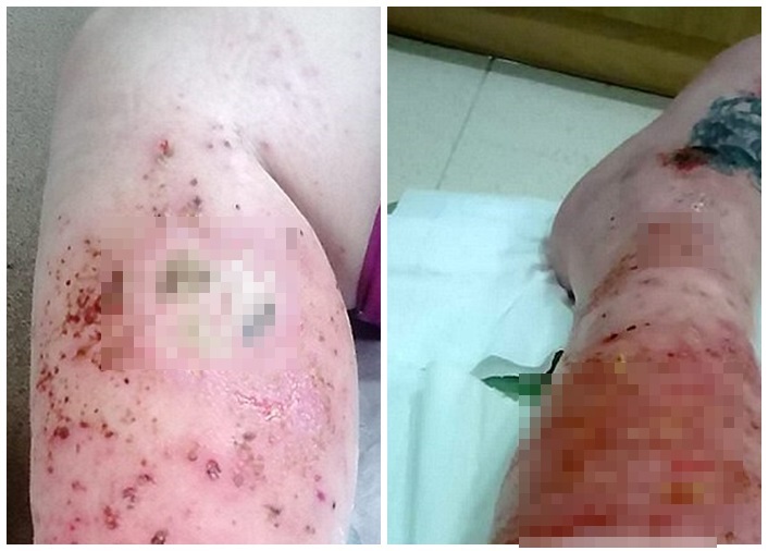 �������˿����ظ�Ⱦ��ҽ��һ�ȿ��ǰ����õļ����г���