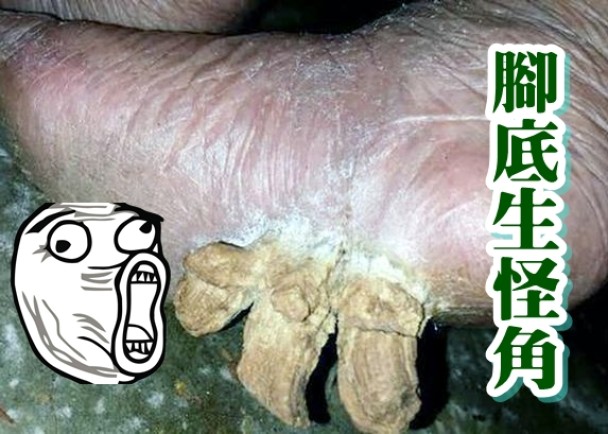 该名妇人脚底长出的怪角,外形极为吓人。