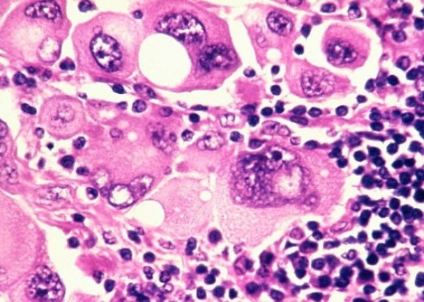 专家指长期接触紫外线可能增加罹患皮肤癌的风险