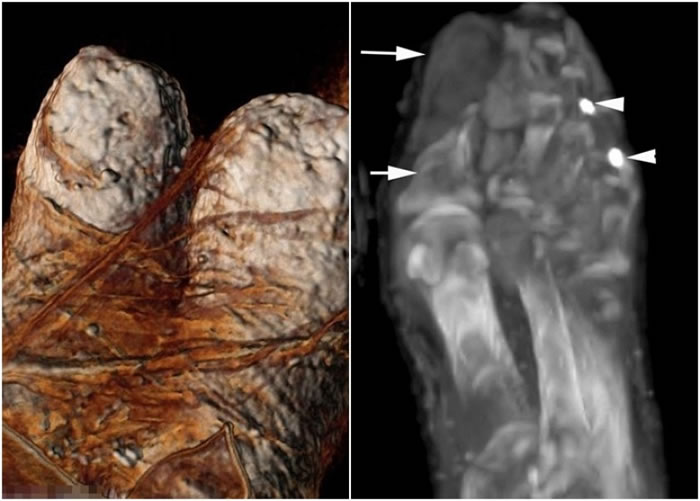 扫描显示(右图),拉美西斯三世的大拇趾(左图)有被人以斧砍过的伤口(箭嘴示)。