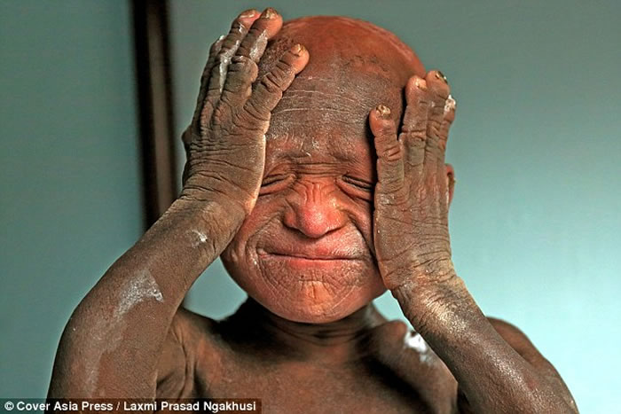 尼泊尔男童患鱼鳞癣 不能说话行走如石头人