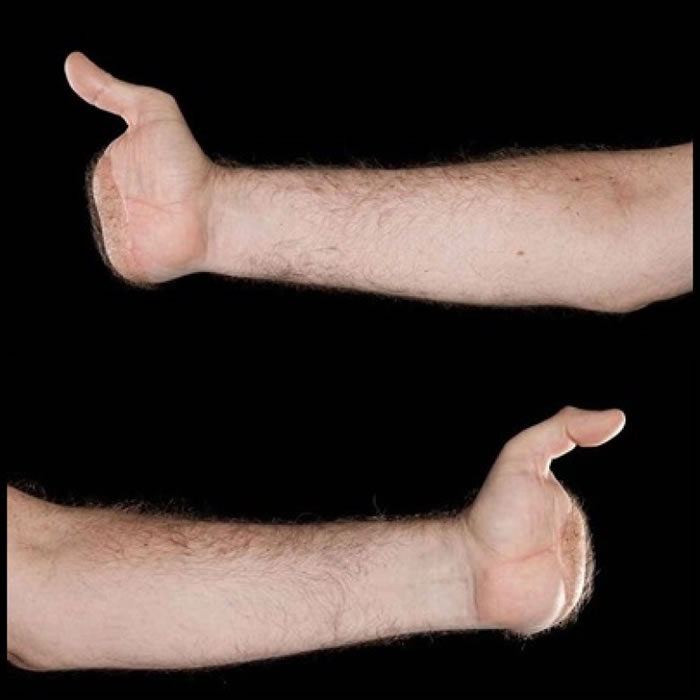 金在接受手术前,左右手都仅剩一只拇指。