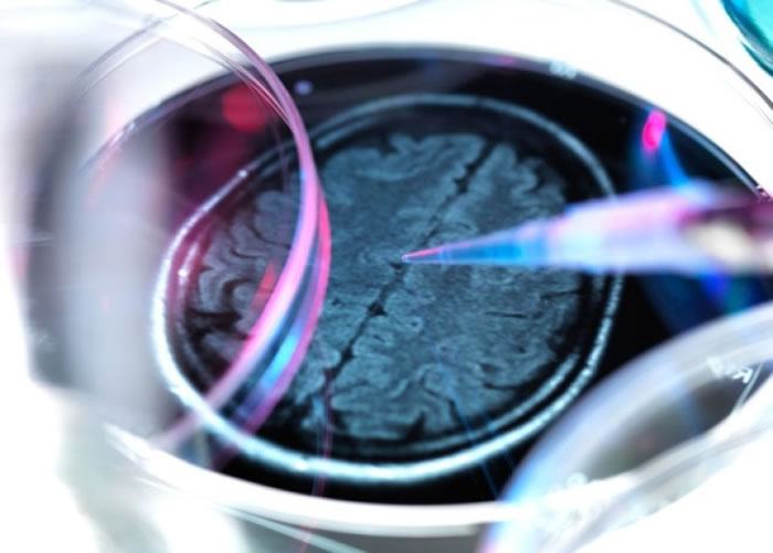 有效清除致病蛋白 治认知障碍症新药“Aducanumab”将面世