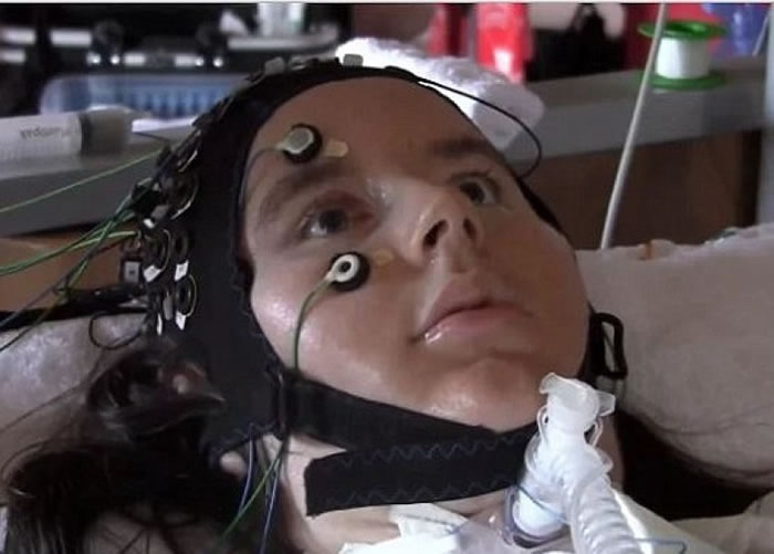 多名渐冻人症患者参与研究。