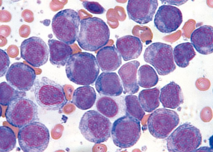 人工病毒有助免疫系统识别癌细胞。图为血癌细胞。(资料图片)