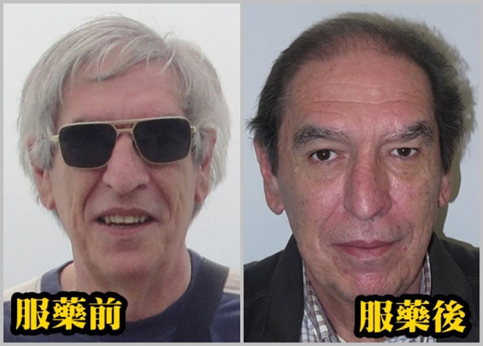 其中一名患者的发色,在服药前后大有分别。