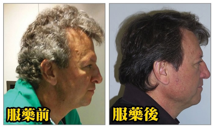 一名患者的头发就似是经过染黑。