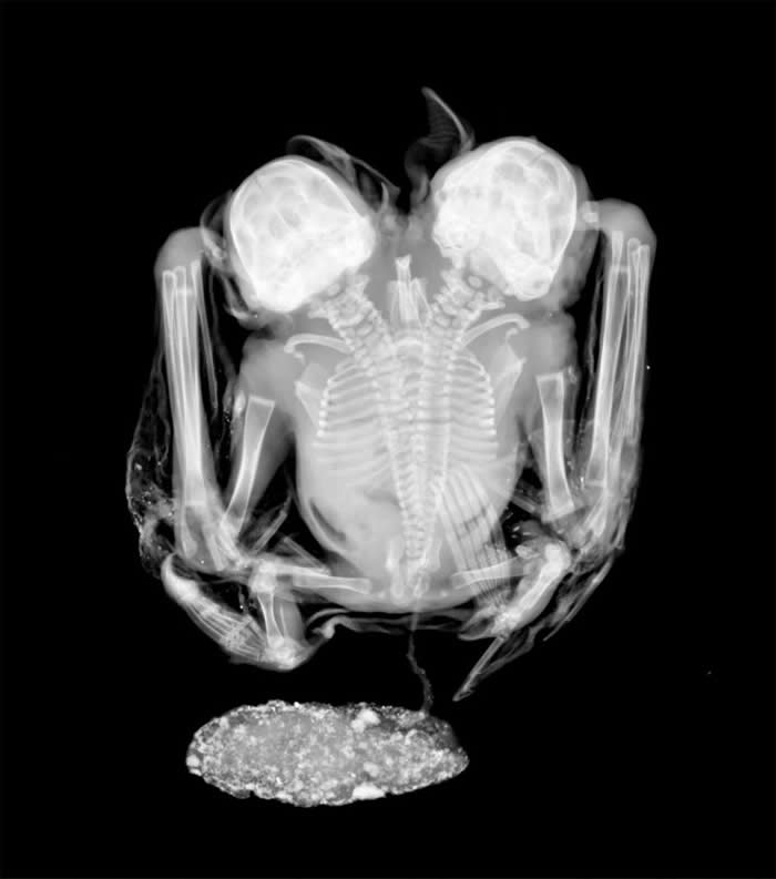 X����Ƭ��ʾ����������Ӥ������ϵļ�׵�� PHOTOGRAPH BY LABORAT&Oacute;RIO DE RADIOGRAFIAS, DIVIS&Ati