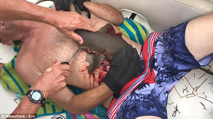 美国佛罗里达州潜水男子下腹遭小鲨鱼紧咬住 强行割开鲨鱼嘴捡回一条命