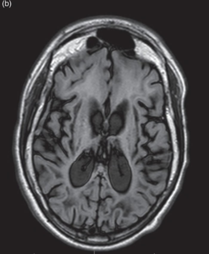 肾上腺脑白质退化症患者的脑部影像。