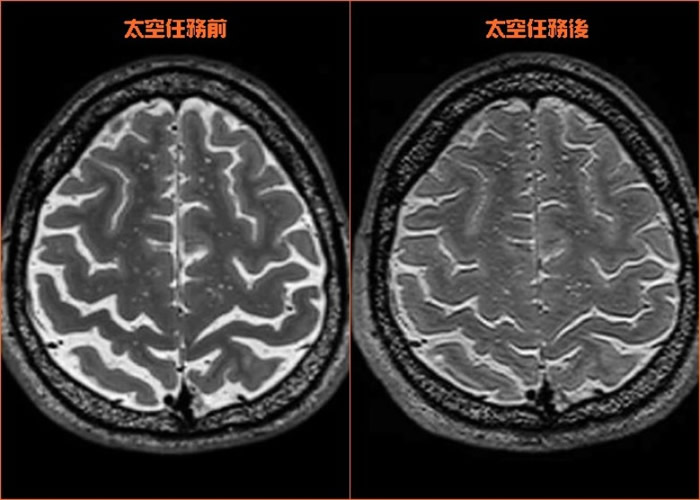 离开地球愈长时间的宇航员,其大脑组织出现的变化愈明显。