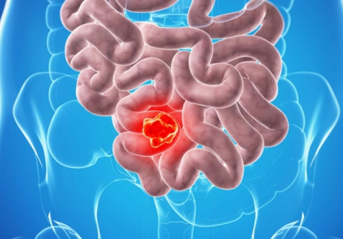 英国医药公司正试验新方法以血液测试检查肠癌