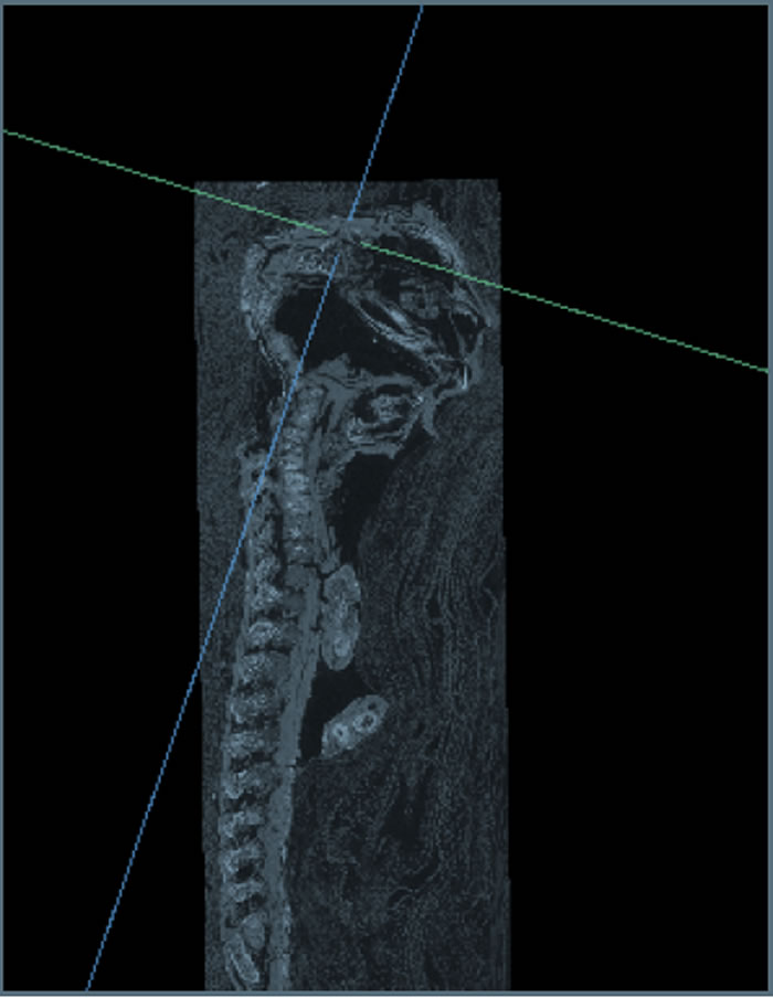 2100年历史的“鹞鹰”木乃伊实际上是有许多疾病的死胎