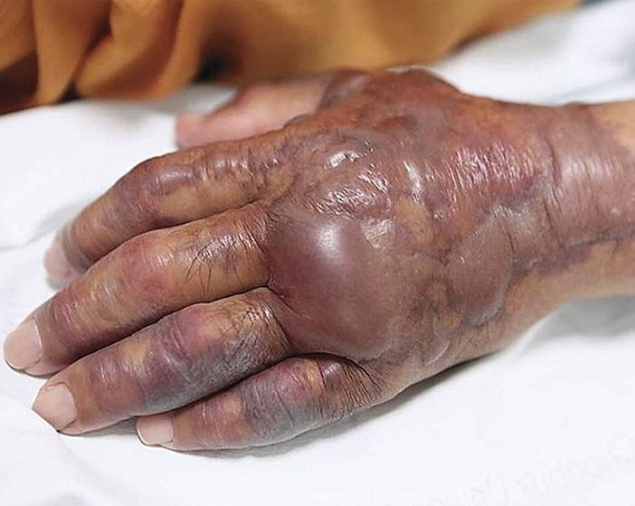 韩国身患糖尿病的老翁进食鱼生寿司时不幸感染创伤弧菌 前臂需要切除